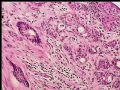 乳头下肿块－浸润性导管癌图9
