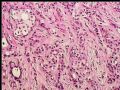 乳头下肿块－浸润性导管癌图10