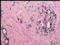 乳头下肿块－浸润性导管癌图13