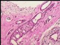 乳头下肿块－浸润性导管癌图14