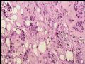 乳头下肿块－浸润性导管癌图15