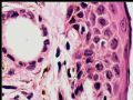 乳头下肿块－浸润性导管癌图16