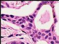 乳头下肿块－浸润性导管癌图17