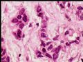 乳头下肿块－浸润性导管癌图18