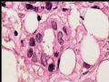 乳头下肿块－浸润性导管癌图19