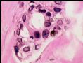 乳头下肿块－浸润性导管癌图20