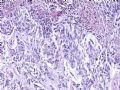 食管癌分型－－肉瘤样癌图5