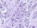 食管癌分型－－肉瘤样癌图7