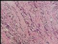 腹膜后肿块－最后诊断：转移性精原细胞瘤图1