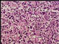 腹膜后肿块－最后诊断：转移性精原细胞瘤图4
