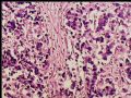 腹膜后肿块－最后诊断：转移性精原细胞瘤图5