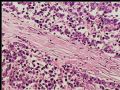 腹膜后肿块－最后诊断：转移性精原细胞瘤图6
