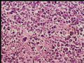腹膜后肿块－最后诊断：转移性精原细胞瘤图7
