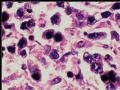 腹膜后肿块－最后诊断：转移性精原细胞瘤图8
