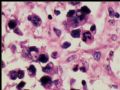 腹膜后肿块－最后诊断：转移性精原细胞瘤图9