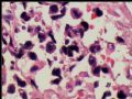 腹膜后肿块－最后诊断：转移性精原细胞瘤图10