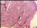 右乳肿块－－分泌性癌图3