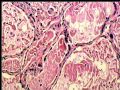 右乳肿块－－分泌性癌图4