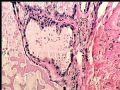 右乳肿块－－分泌性癌图8
