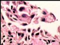 右乳肿块－－分泌性癌图11