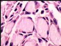 右乳肿块－－分泌性癌图12