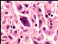 右乳肿块－－分泌性癌图13