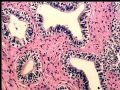 右肾肿瘤－－混合性上皮间质肿瘤（mixed epithelial and stromal tumor）图6