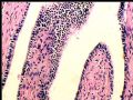 右肾肿瘤－－混合性上皮间质肿瘤（mixed epithelial and stromal tumor）图7