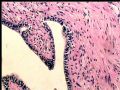 右肾肿瘤－－混合性上皮间质肿瘤（mixed epithelial and stromal tumor）图8