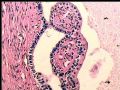 右肾肿瘤－－混合性上皮间质肿瘤（mixed epithelial and stromal tumor）图10