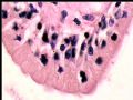 右肾肿瘤－－混合性上皮间质肿瘤（mixed epithelial and stromal tumor）图11