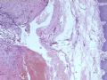 舌体肿物--乳头状血管内皮细胞增生图1