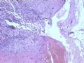 舌体肿物--乳头状血管内皮细胞增生图2