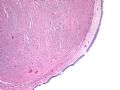 阴道肿瘤_ 肌纤维母细胞瘤图1