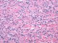 阴道肿瘤_ 肌纤维母细胞瘤图3