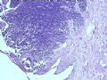 膀胱肿物--膀胱神经内分泌癌图1