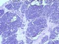 膀胱肿物--膀胱神经内分泌癌图2