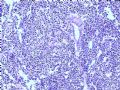 膀胱肿物--膀胱神经内分泌癌图4
