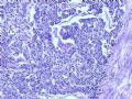 膀胱肿物--膀胱神经内分泌癌图6