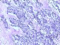 膀胱肿物--膀胱神经内分泌癌图7