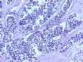 膀胱肿物--膀胱神经内分泌癌图8