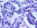 膀胱肿物--膀胱神经内分泌癌图9