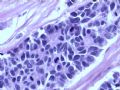 膀胱肿物--膀胱神经内分泌癌图10