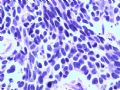膀胱肿物--膀胱神经内分泌癌图12