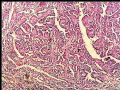 左肾肿瘤－－乳头状肾细胞癌图1
