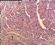左肾肿瘤－－乳头状肾细胞癌图2