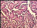 左肾肿瘤－－乳头状肾细胞癌图3