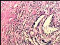 左肾肿瘤－－乳头状肾细胞癌图4