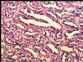 左肾肿瘤－－乳头状肾细胞癌图5