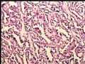 左肾肿瘤－－乳头状肾细胞癌图6